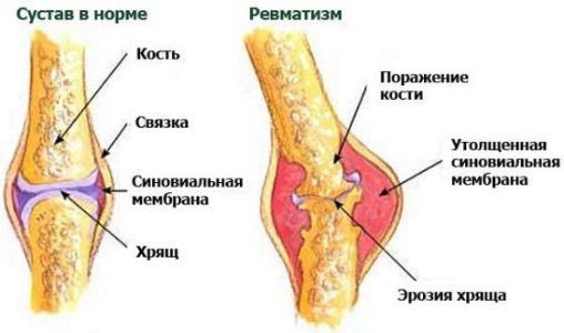 Ревматизм.jpg