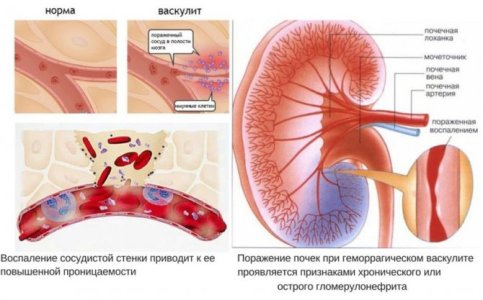 Геморрагический васкулит.jpg