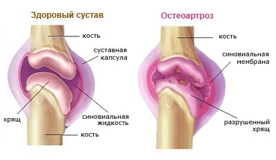Деформирующий остеоартроз.jpg