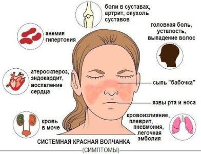 Системная красная волчанка.jpg