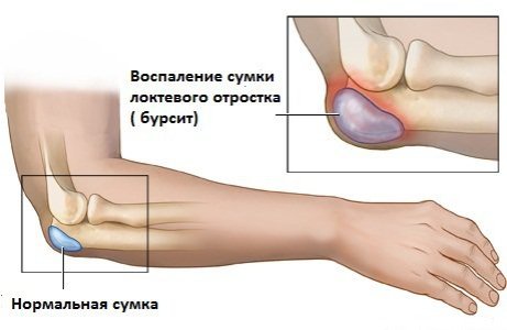 Бурсит.jpg