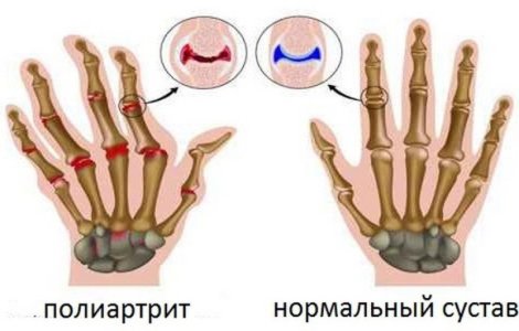 Полиартрит.jpg