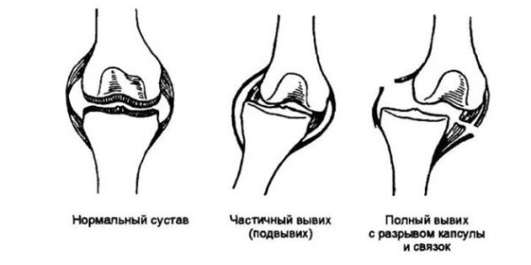 Вывих.jpg
