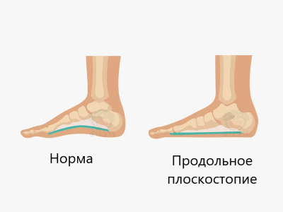 Плоскостопие.png