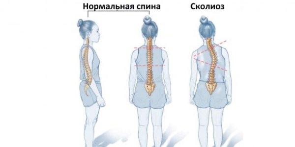 Сколиоз.jpg