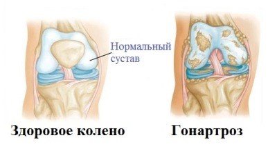 Гонартроз.jpg