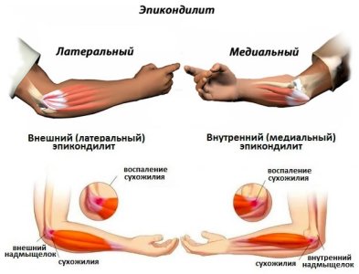 Эпикондилит.jpg