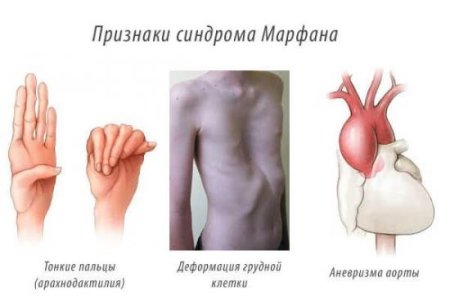 Синдром Марфана.jpg