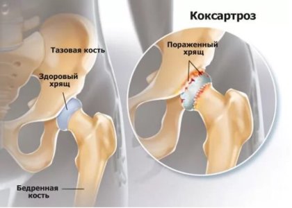 Коксартроз.jpg