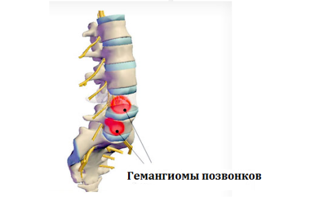 Гемангиома позвоночника.png