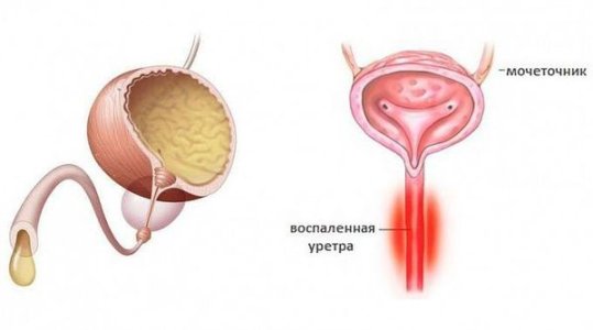Уретрит.jpg