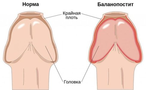 Баланопостит.jpg