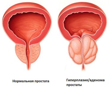Аденома простаты.jpg