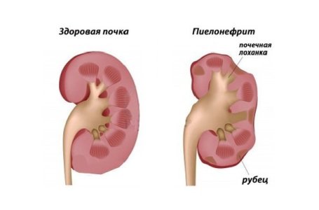 Пиелонефрит.jpg