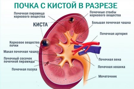 Киста почек.jpg