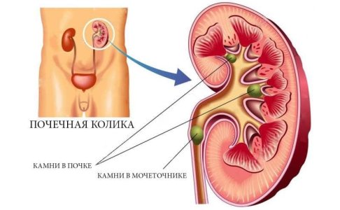 Почечная колика.jpg