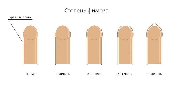 Фимоз.jpg