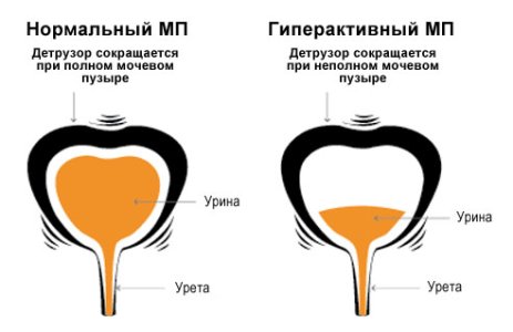 Гиперактивный мочевой пузырь.jpg