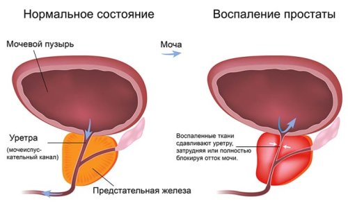 Воспаление предстательной железы.jpg
