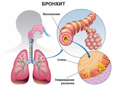 бронхит.jpg