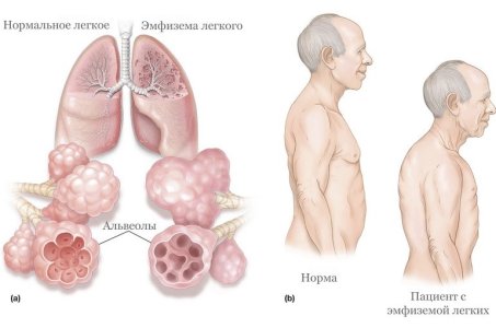 Эмфизема легких.jpg