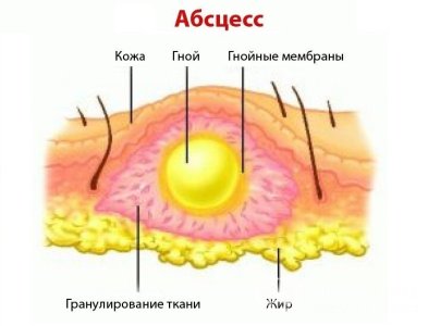 Абсцесс.jpg