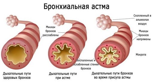 Бронхиальная астма.jpg