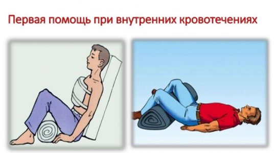 Внутреннее кровотечение.jpg
