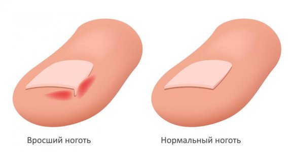 Вросший ноготь.jpg