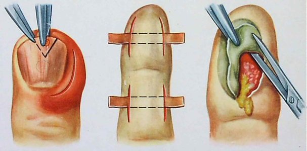 Панариций.jpg