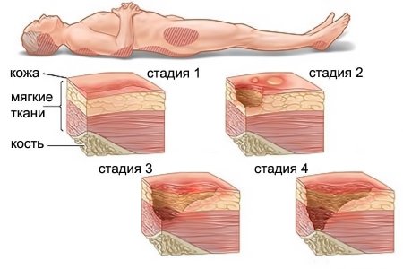Пролежни.jpg