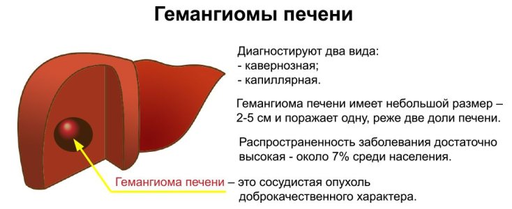 Гемангиома печени.jpg