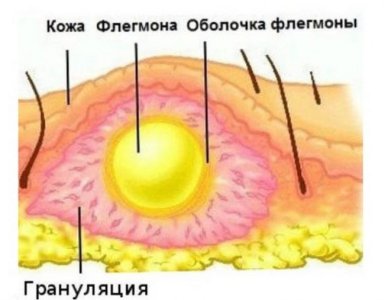 Флегмона.jpg