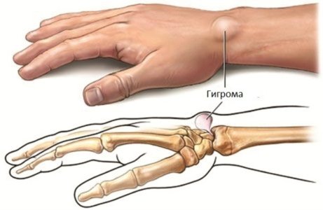 Гигрома.jpg