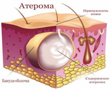 Атерома.jpg
