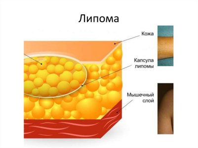 Липома.jpg