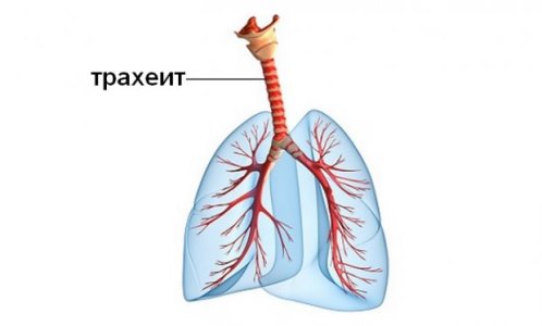 Трахеит.jpg