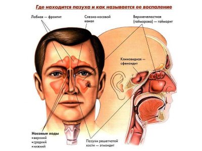 Этмоидит.jpg