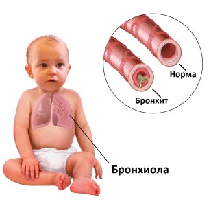 Бронхит у детей.jpg