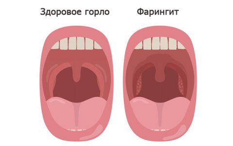 Фарингит у детей.jpg