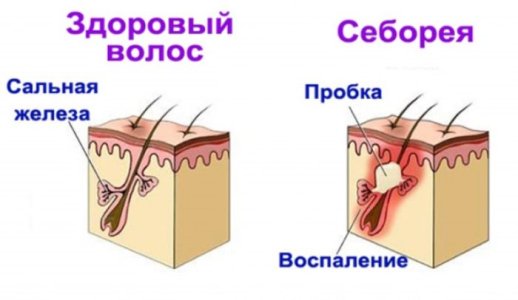 Себорея.jpg