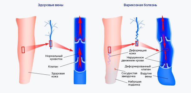 Ретикулярный варикоз.jpg