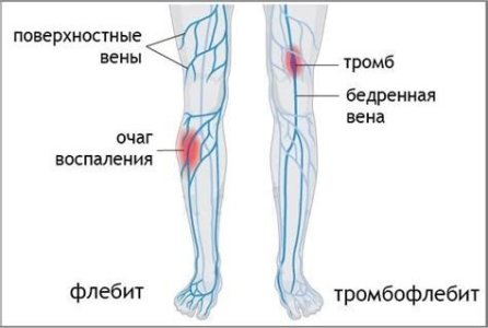 флебит.jpg