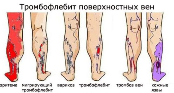 Восходящий тромбофлебит.jpg
