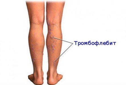 Мигрирующий тромбофлебит.jpg