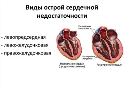 Сердечная недостаточность.jpg