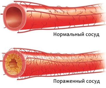 Атеросклероз.jpg