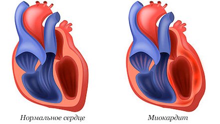 myocarditis.jpg