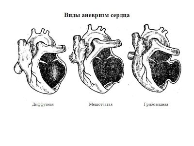 Аневризма сердца.jpg