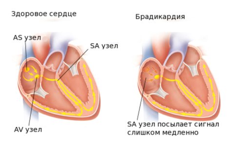 Брадикардия.jpg